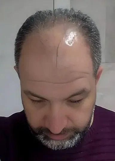 hair transplant 4 before