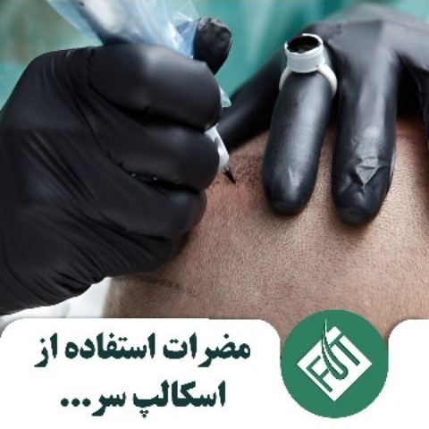 مضرات استفاده از اسکالپ سر