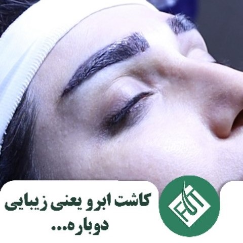 کاشت ابرو یعنی زیبایی دوباره 1 کاشت ابرو یعنی زیبایی دوباره