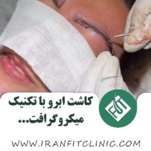 کاشت ابرو با تکنیک میکروگرافت2