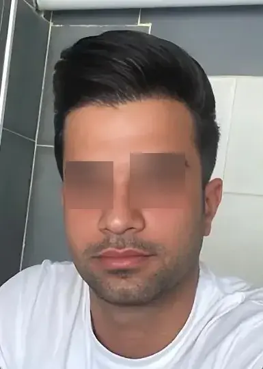 تصویر بعد از کاشت مو 1