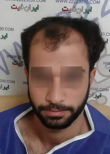 صفحه اصلی 4 تصویر قبل از کاشت مو 1