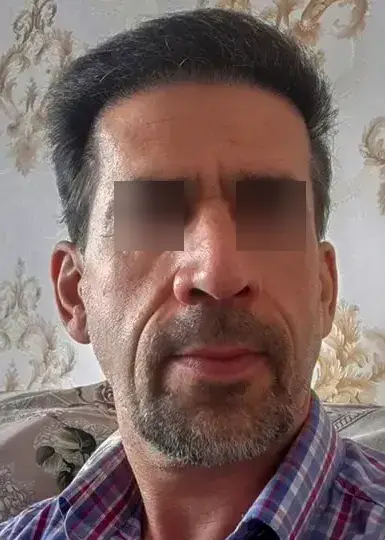 تصویر بعد از کاشت مو 2