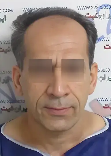 صفحه اصلی 6 تصویر قبل از کاشت مو 2