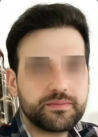 تصویر بعد از کاشت مو 3