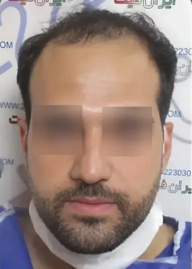 صفحه اصلی 8 تصویر قبل از کاشت مو 3