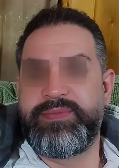 تصویر بعد از کاشت مو 4