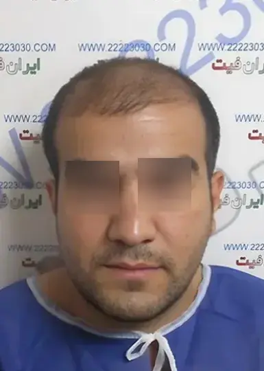 صفحه اصلی 12 تصویر قبل از کاشت مو 6