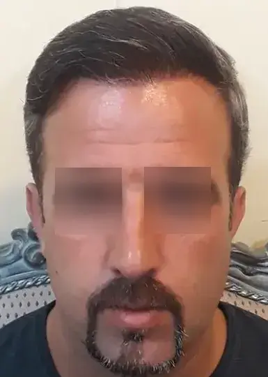 تصویر بعد از کاشت مو 7