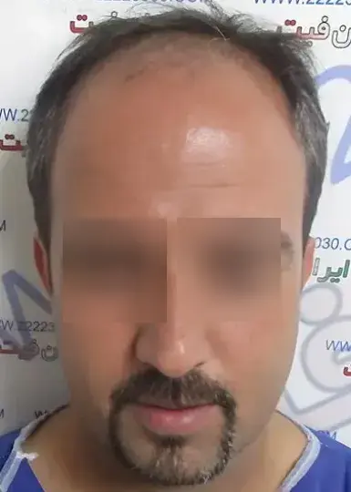 صفحه اصلی 16 تصویر قبل از کاشت مو 7