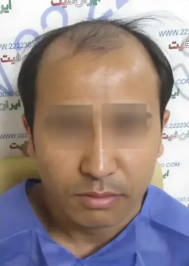 صفحه اصلی 14 تصویر قبل از کاشت مو 8