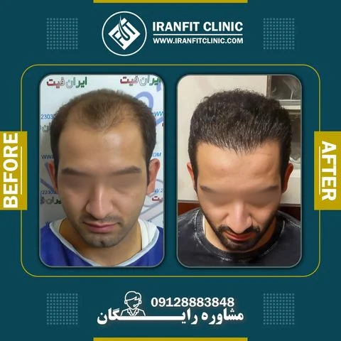 رضایت از کاشت مو در ایران فیت با تصویر قبل و بعد