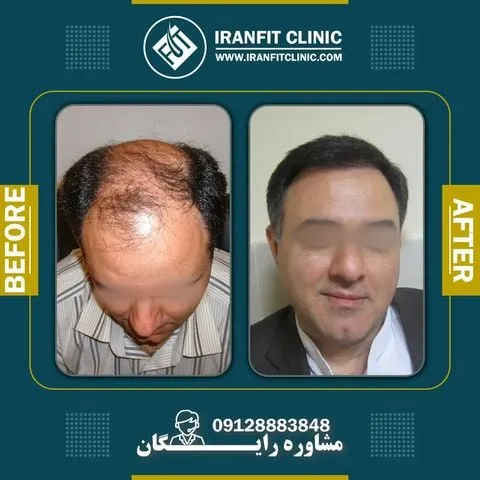 عکس رضایت مراجعه کننده از کاشت مو