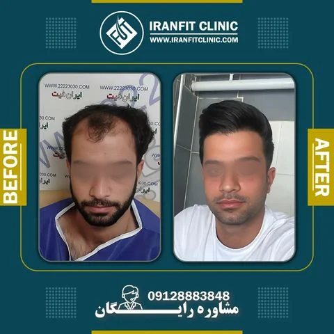 عکس قبل و بعد از کاشت مو