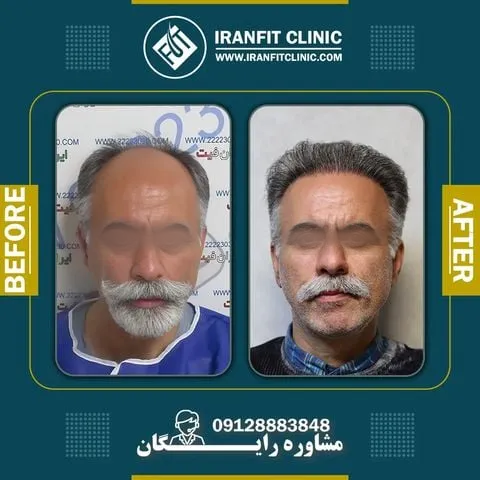 نمونه عکس کاشت مو در کلینیک ایران فیت