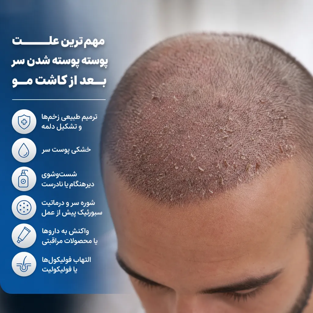 مهم‌ترین علت پوسته پوسته شدن سر بعد از کاشت مو